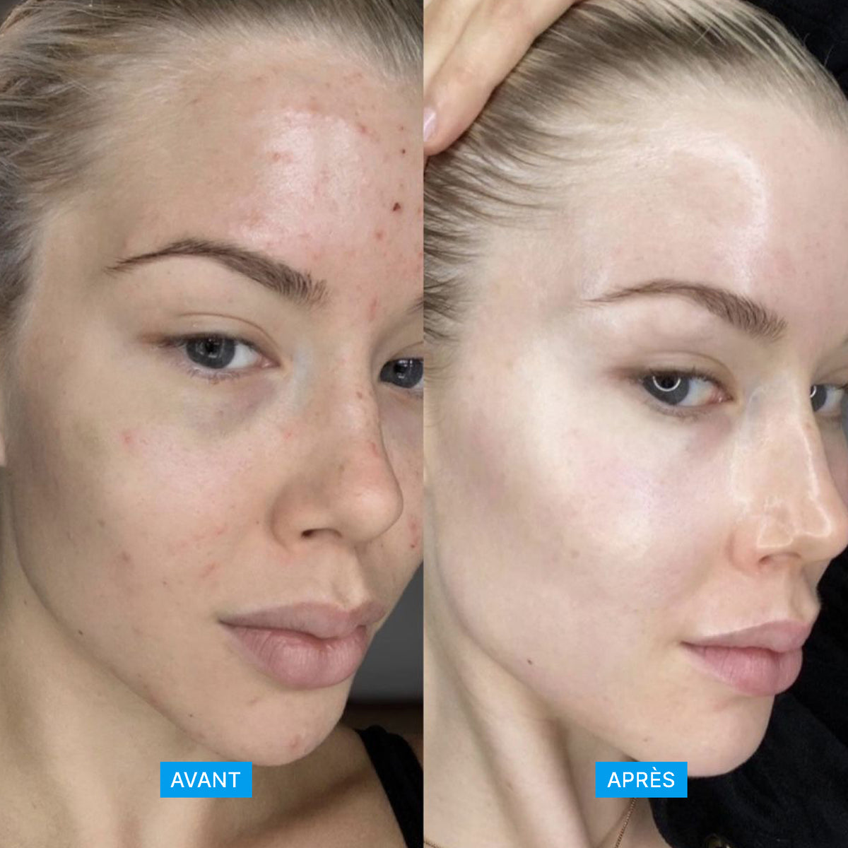 Soin_anti-imperfections_visage
