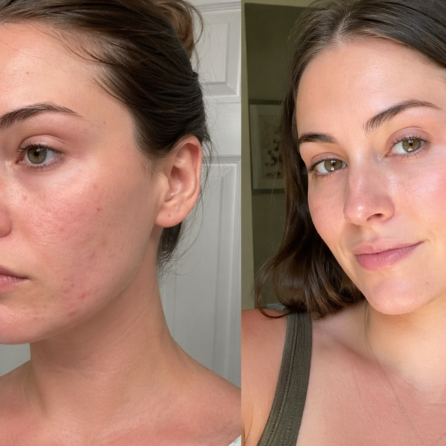 Acne Treatment
