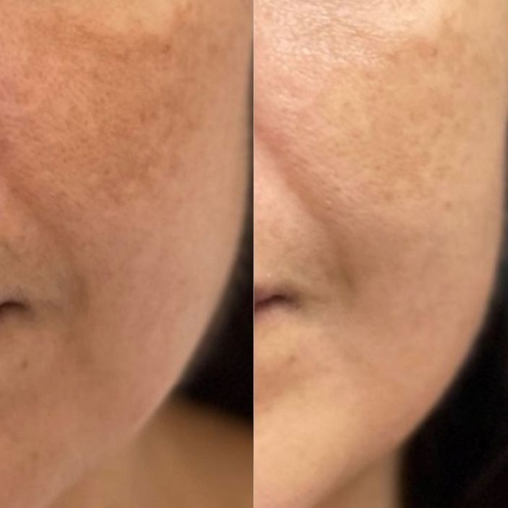 Brownish patches often found on the cheeks, forehead, or upper lip, commonly triggered by hormonal changes.