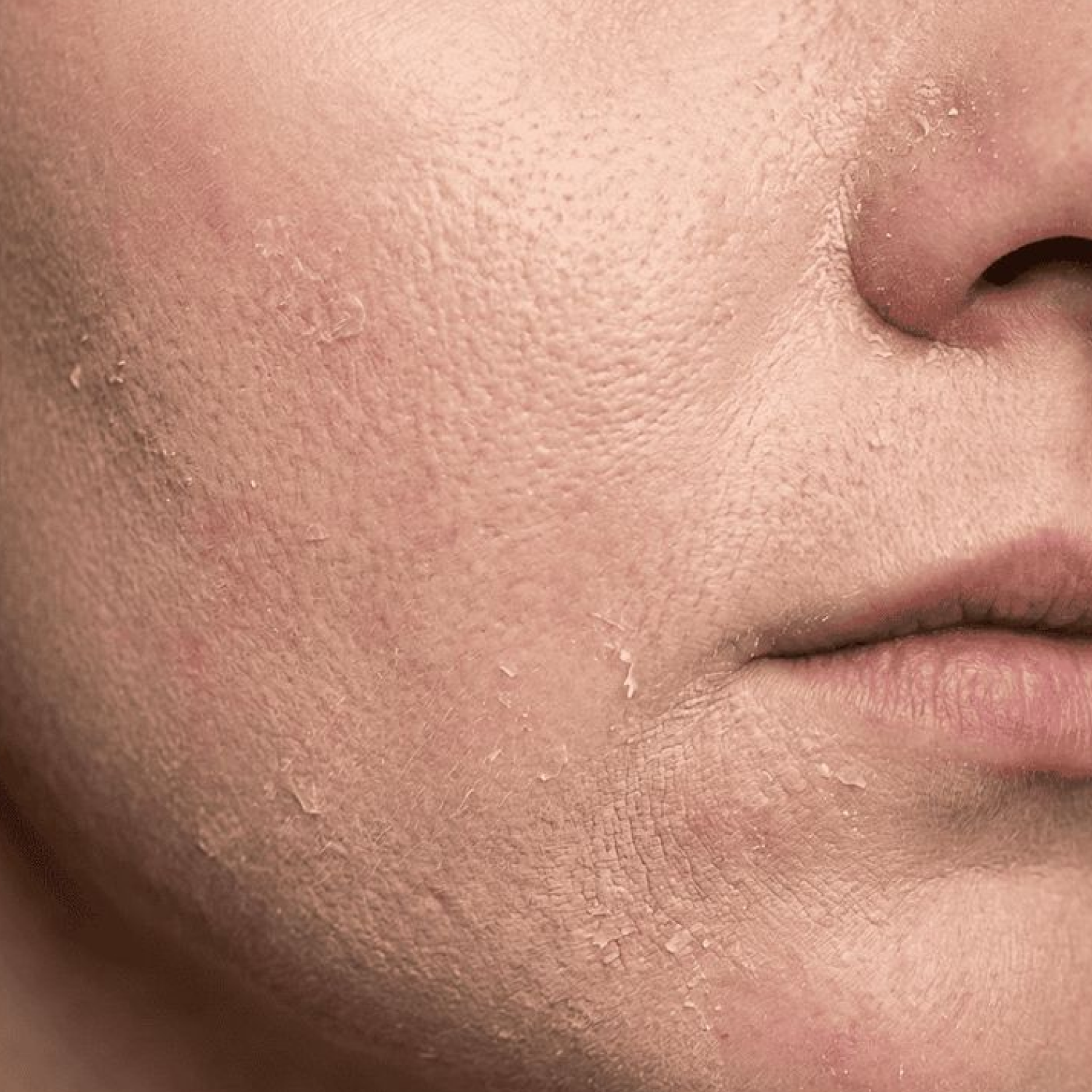 Over-exfoliation: Using harsh physical scrubs or too many chemical exfoliants (like AHAs or BHAs).